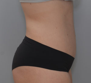 Abdominoplasty Before & After Patient #1385