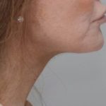 Neck Liposuction Before & After Patient #2003