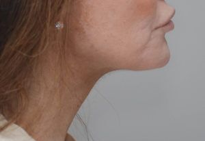 Neck Liposuction Before & After Patient #2003