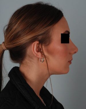 Rhinoplasty Before & After Patient #2113