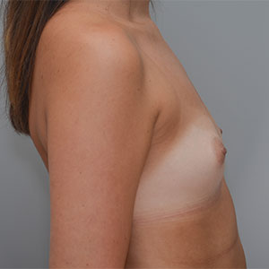 Breast Augmentation Before & After Patient #358