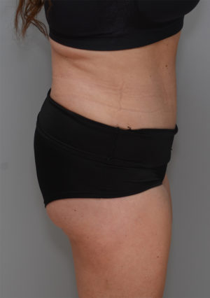 Abdominoplasty Before & After Patient #1211