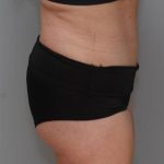 Abdominoplasty Before & After Patient #1590