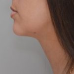 Neck Liposuction Before & After Patient #1948