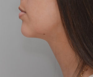 Neck Liposuction Before & After Patient #1948