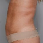 Liposuction with Bodytite Before & After Patient #1557