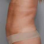 Liposuction Before & After Patient #1646