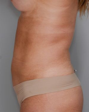 Liposuction Before & After Patient #1646