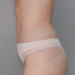 Abdominoplasty Before & After Patient #1270