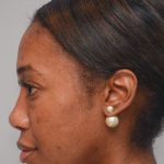 Non-Surgical Rhinoplasty Before & After Patient #2248