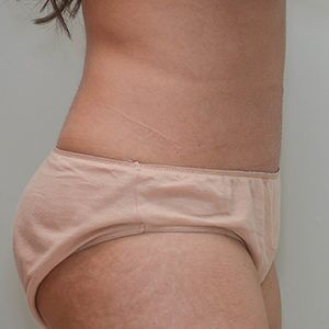 Liposuction Before & After Patient #1587