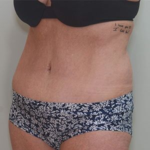 Abdominoplasty Before & After Patient #1209