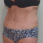 Abdominoplasty Before & After Patient #1588