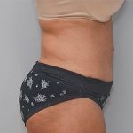 Abdominoplasty Before & After Patient #1207