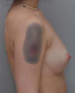 Breast Augmentation Before & After Patient #195