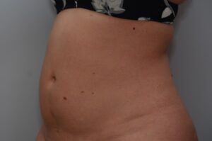 Emsculpt Neo Before & After Patient #2174