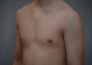 Gynecomastia Before & After Patient #1160