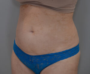 Liposuction with Bodytite Before & After Patient #1558