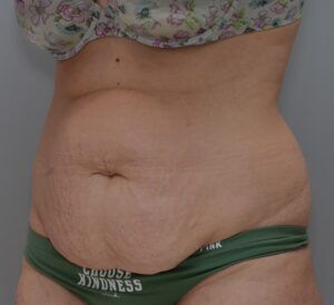 Abdominoplasty Before & After Patient #1496