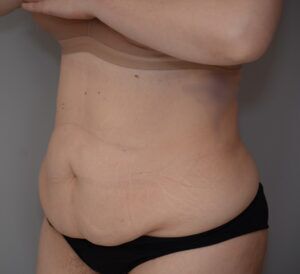 Abdominoplasty Before & After Patient #1494