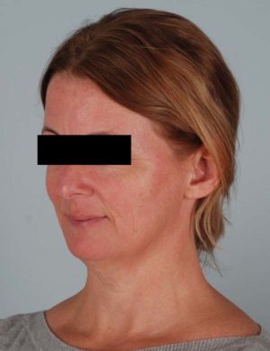 Face And Neck Lift Before & After Patient #1743