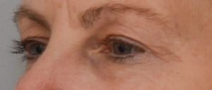 Blepharoplasty Before & After Patient #1704