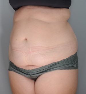 Abdominoplasty Before & After Patient #1271