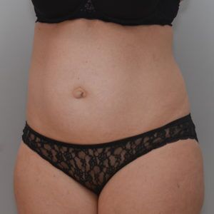 Abdominoplasty Before & After Patient #1387