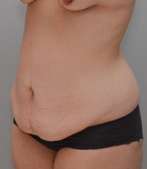 Abdominoplasty Before & After Patient #1440