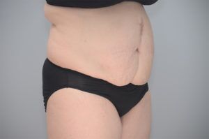 Abdominoplasty Before & After Patient #1210