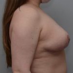 Breast Reduction Before & After Patient #1131