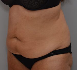 Abdominoplasty Before & After Patient #1443