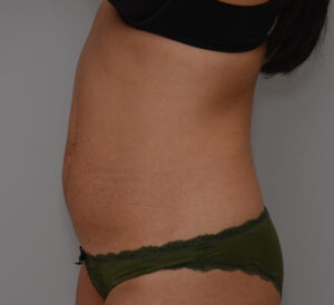 Abdominoplasty Before & After Patient #1441