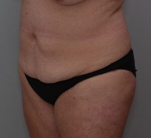 Abdominoplasty Before & After Patient #1444