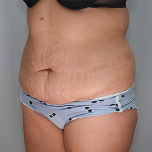 Abdominoplasty Before & After Patient #1273