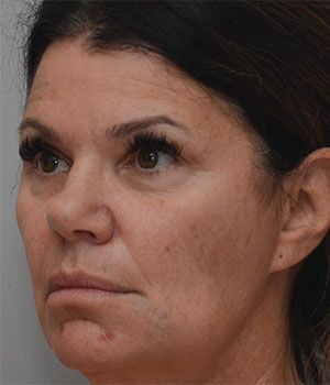 Laser Skin Resurfacing Before & After Patient #2230