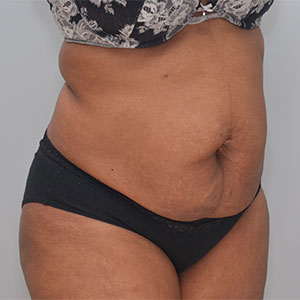 Abdominoplasty Before & After Patient #1384