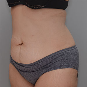 Abdominoplasty Before & After Patient #1383