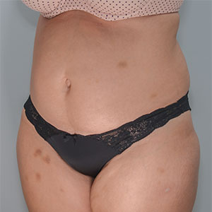 Abdominoplasty Before & After Patient #1329