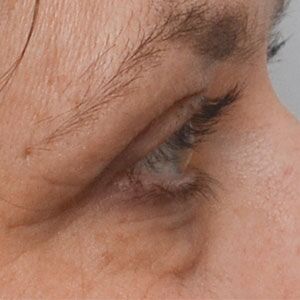 Blepharoplasty Before & After Patient #1700