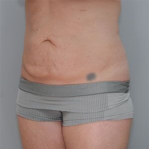 Abdominoplasty Before & After Patient #1272