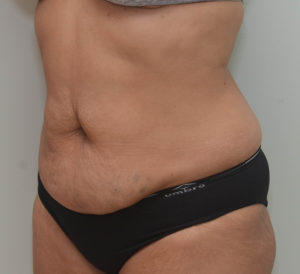 Abdominoplasty Before & After Patient #1386