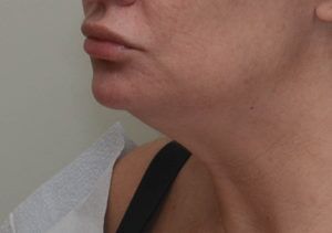 Neck Liposuction Before & After Patient #2003