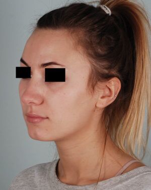 Rhinoplasty Before & After Patient #2113