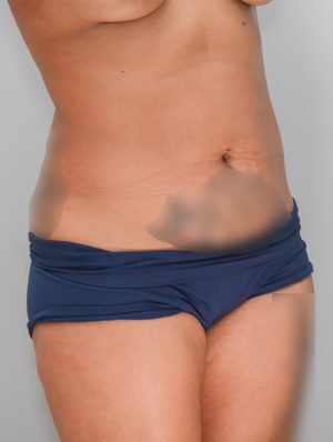 Abdominoplasty Before & After Patient #1269