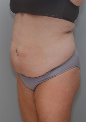 Abdominoplasty Before & After Patient #1211