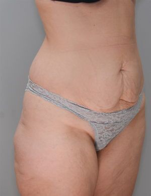 Abdominoplasty Before & After Patient #1270