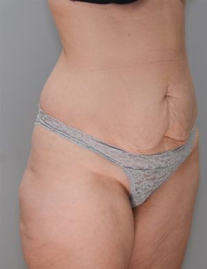 Liposuction Before & After Patient #1642