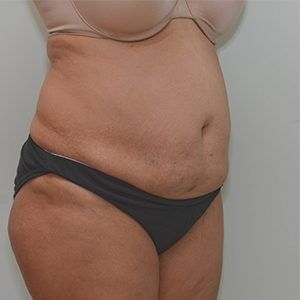 Abdominoplasty Before & After Patient #1207