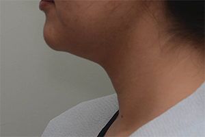 Neck Liposuction Before & After Patient #2004